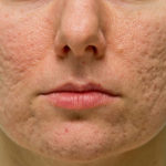 Qu’est-ce que le resurfaçage au laser pour les cicatrices d’acné ?