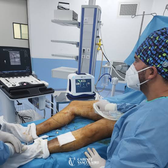 Laser endoveineux